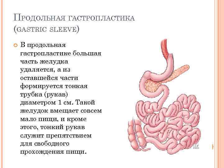 ПРОДОЛЬНАЯ ГАСТРОПЛАСТИКА (GASTRIC SLEEVE) В продольная гастропластике большая часть желудка удаляется, а из оставшейся