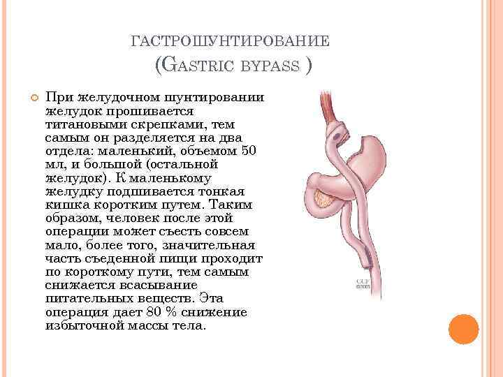 ГАСТРОШУНТИРОВАНИЕ (GASTRIC BYPASS ) При желудочном шунтировании желудок прошивается титановыми скрепками, тем самым он