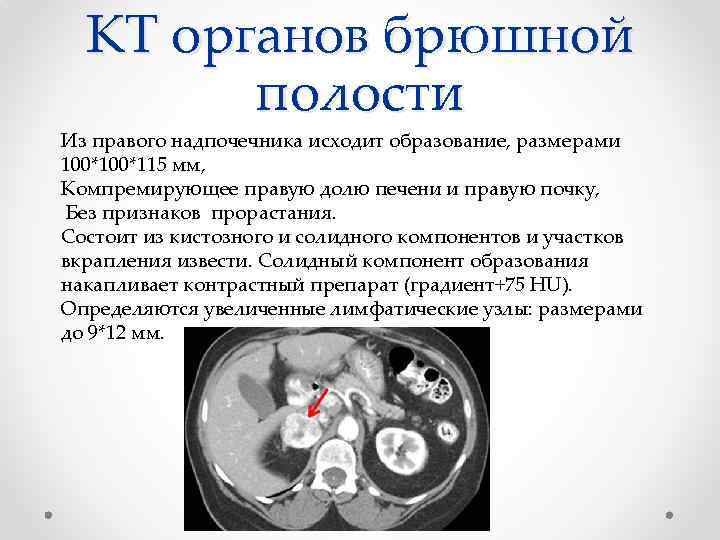 КТ органов брюшной полости Из правого надпочечника исходит образование, размерами 100*115 мм, Компремирующее правую