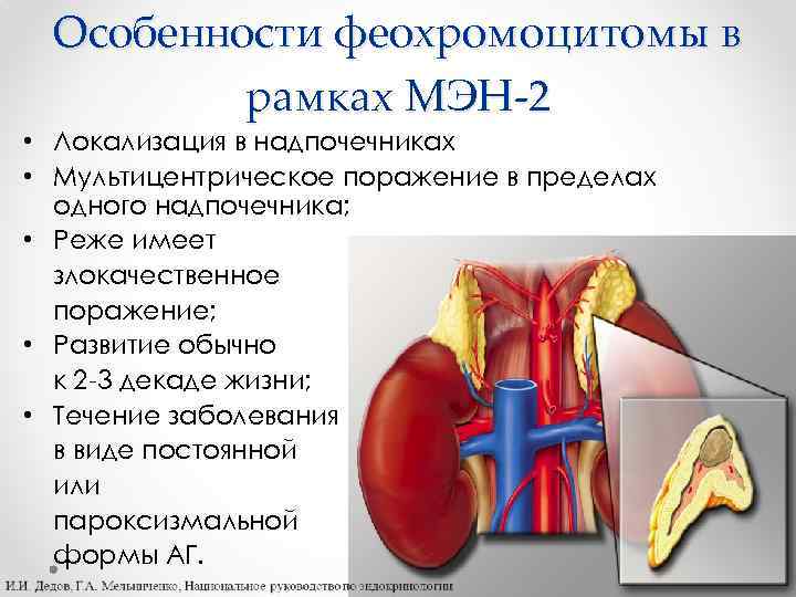 Особенности феохромоцитомы в рамках МЭН-2 • Локализация в надпочечниках • Мультицентрическое поражение в пределах