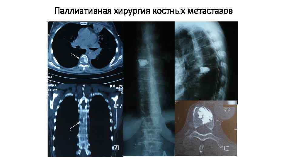 Паллиативная хирургия костных метастазов 