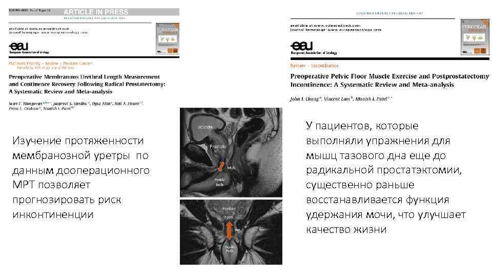 Изучение протяженности мембранозной уретры по данным дооперационного МРТ позволяет прогнозировать риск инконтиненции У пациентов,