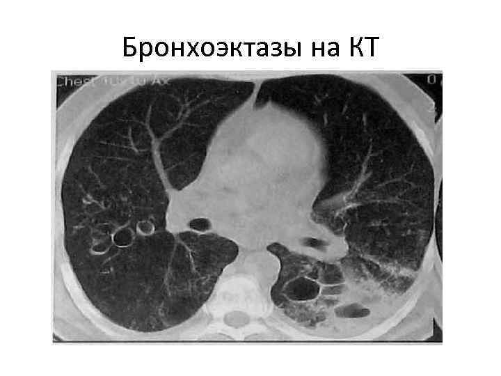 Бронхоэктазы на КТ 