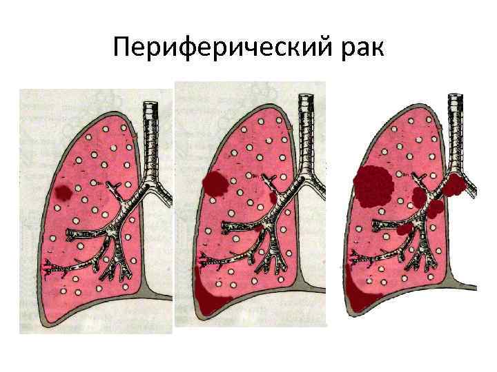 Центр легких. Периферическая опухоль легкого. Центральный и периферический рву. Периферическое заболевание легкого что это. Центральные опухоли легкого и периферические.