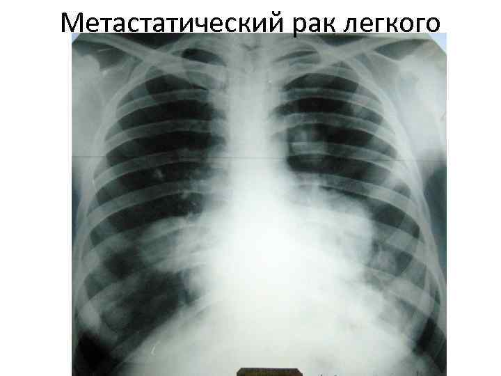 Метастатический рак легкого 