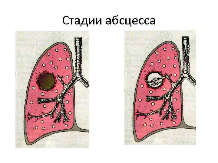Стадии абсцесса 