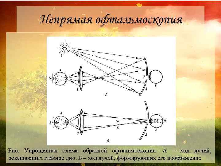 Непрямая офтальмоскопия Рис. Упрощенная схема обратной офтальмоскопии. А – ход лучей, освещающих глазное дно.