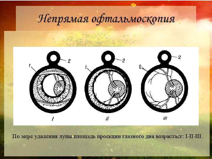 Непрямая офтальмоскопия По мере удаления лупы площадь проекции глазного дна возрастает: I II III.