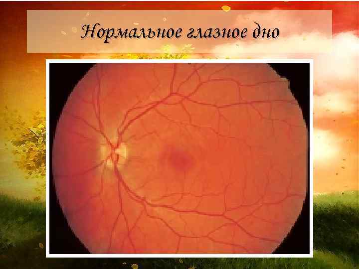 Норма глазного дна. Офтальмоскопия глазного дна норма. Глазное дно при офтальмоскопии норма. Нормальное нлазное Део. Нормальная картина глазного дна.