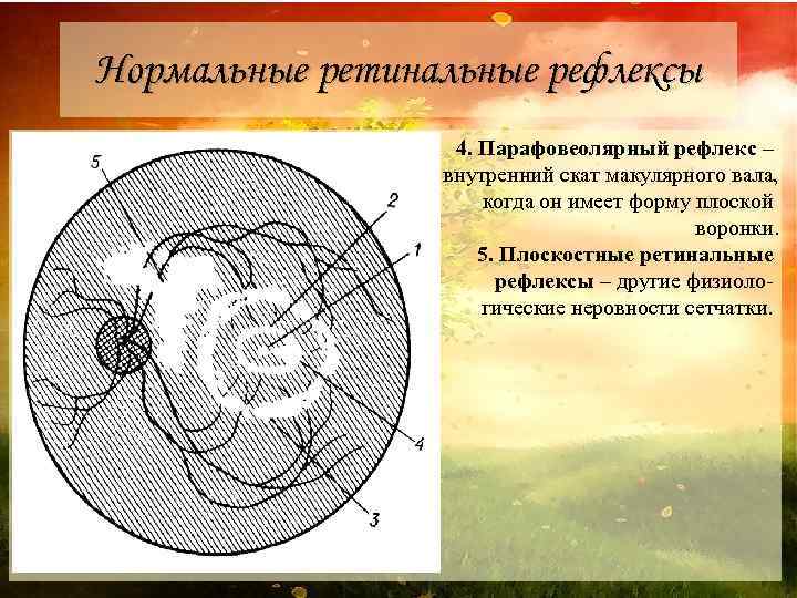 Нормальные ретинальные рефлексы 4. Парафовеолярный рефлекс – внутренний скат макулярного вала, когда он имеет