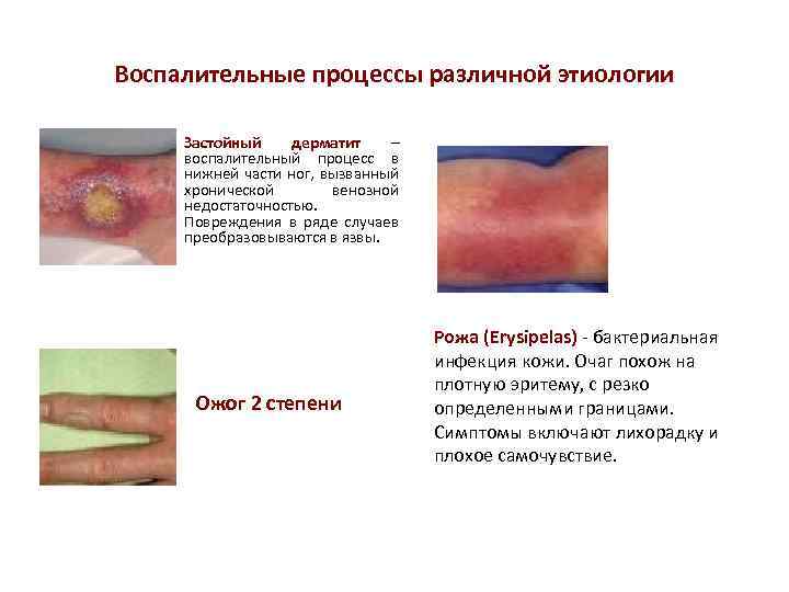 Воспалительные процессы различной этиологии Застойный дерматит – воспалительный процесс в нижней части ног, вызванный