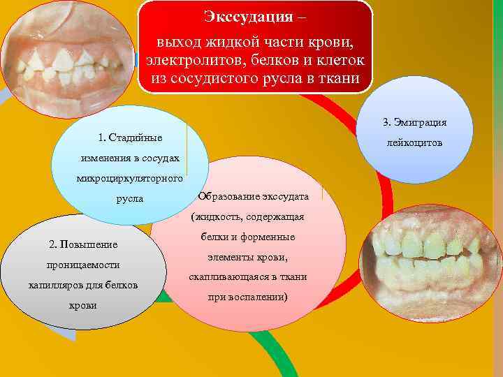 Экссудация – выход жидкой части крови, электролитов, белков и клеток из сосудистого русла в