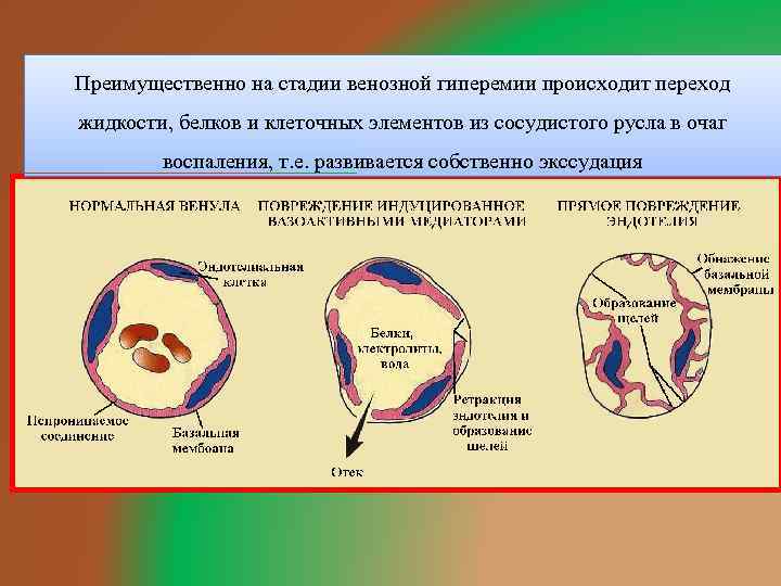 Преимущественно на стадии венозной гиперемии происходит переход жидкости, белков и клеточных элементов из сосудистого