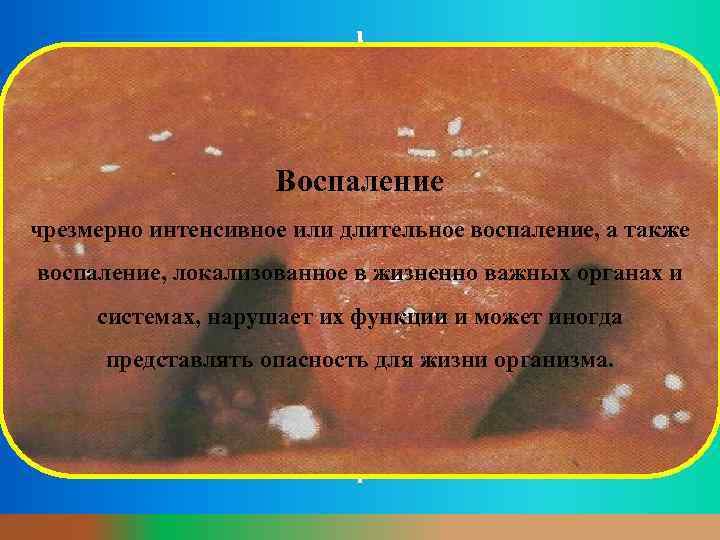 Воспаление чрезмерно интенсивное или длительное воспаление, а также воспаление, локализованное в жизненно важных органах