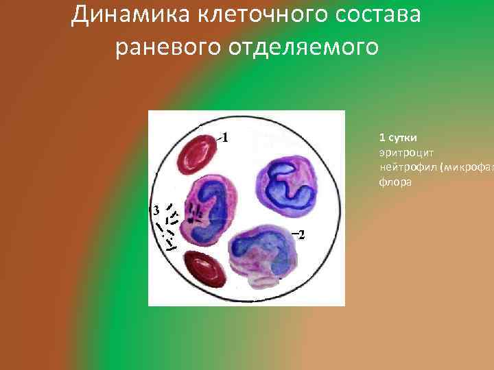 Динамика клеточного состава раневого отделяемого 1 сутки эритроцит нейтрофил (микрофаг флора 