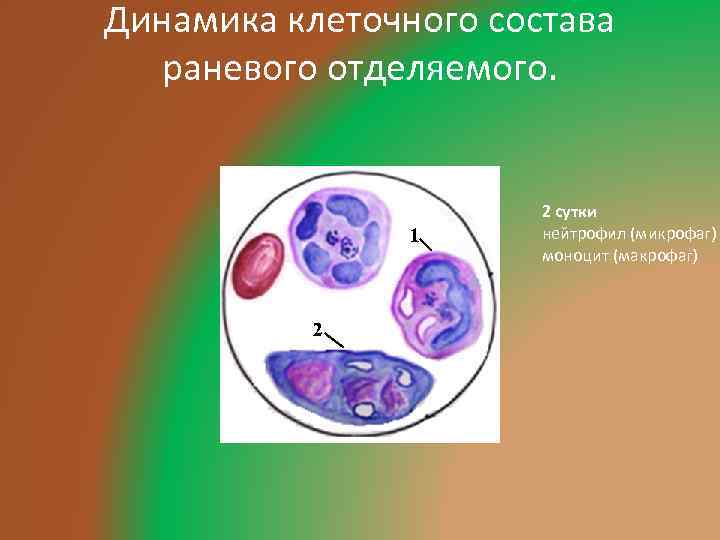 Динамика клеточного состава раневого отделяемого. 2 сутки нейтрофил (микрофаг) моноцит (макрофаг) 