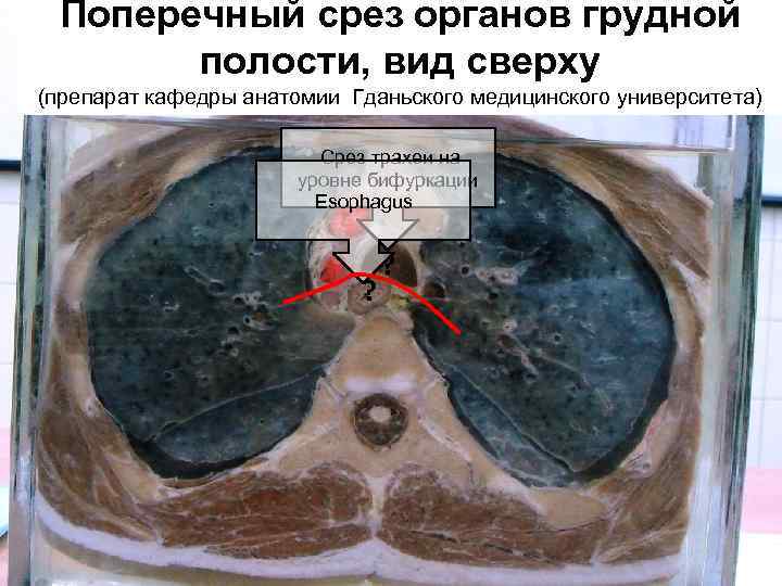 Поперечный срез органов грудной полости, вид сверху (препарат кафедры анатомии Гданьского медицинского университета) Срез