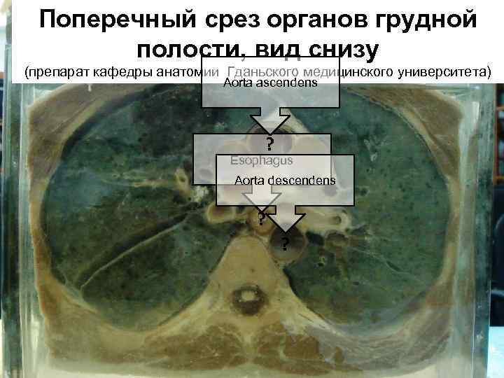 Поперечный срез органов грудной полости, вид cнизу (препарат кафедры анатомии Гданьского медицинского университета) Aorta