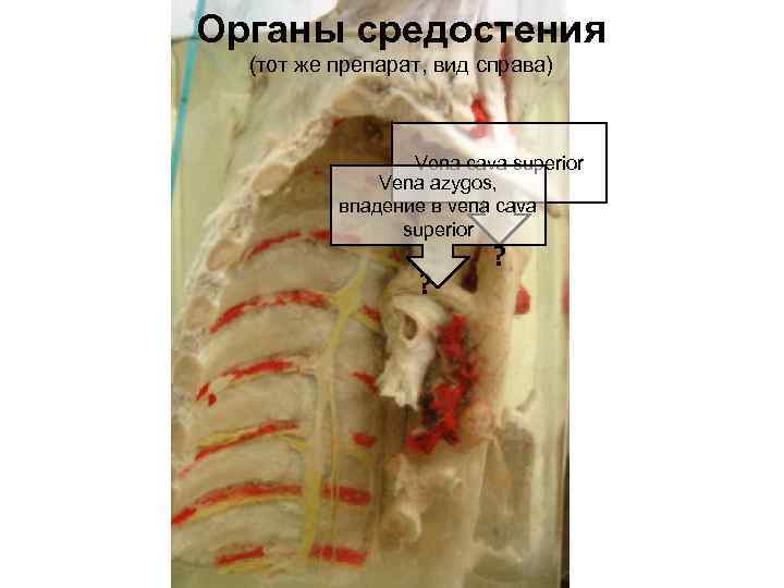 Органы средостения (тот же препарат, вид справа) Vena cava superior Vena azygos, впадение в