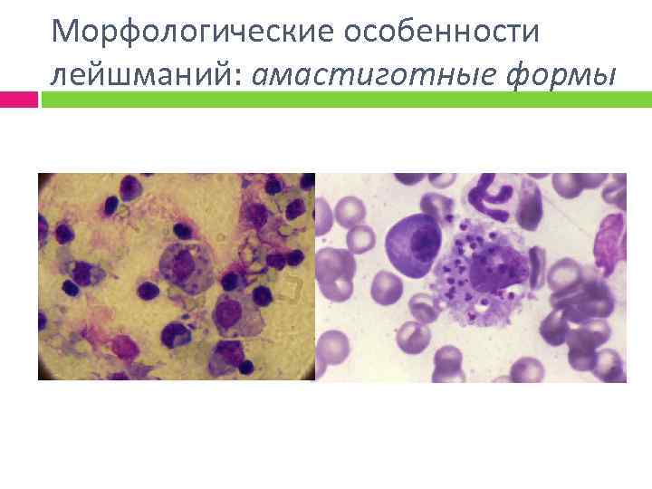 Особенность картины периферической крови при висцеральной форме лейшманиоза