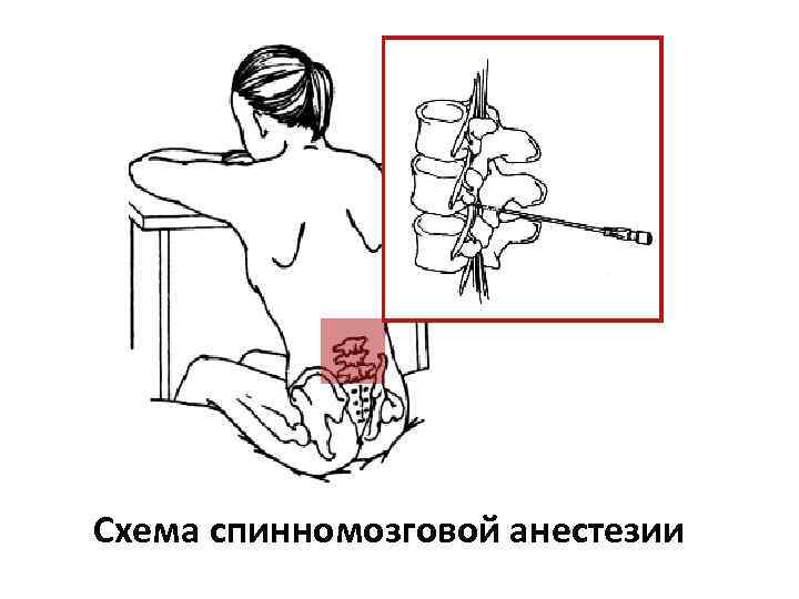 Схема спинномозговой анестезии 