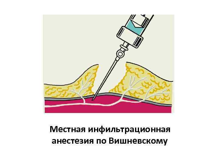 Местная инфильтрационная анестезия по Вишневскому 
