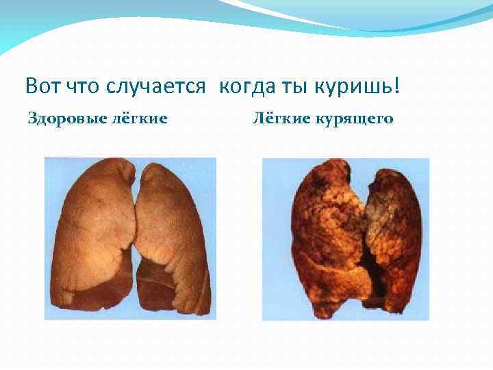 Вот что случается когда ты куришь! Здоровые лёгкие Лёгкие курящего 