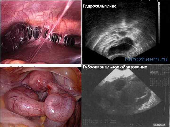 Гидросальпинкс Тубоовариальное образование 