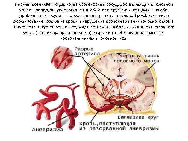 Инсульт возникает тогда, когда кровеносный сосуд, доставляющий в головной мозг кислород, закупоривается тромбом или