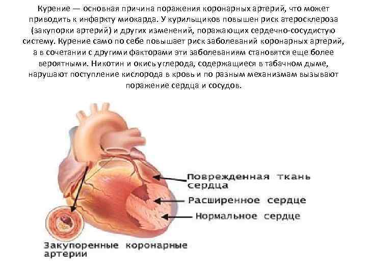 Курение — основная причина поражения коронарных артерий, что может приводить к инфаркту миокарда. У