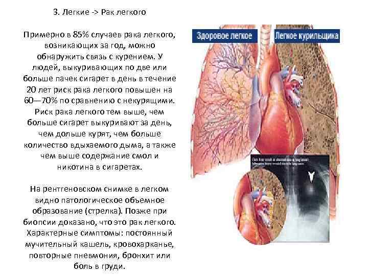 3. Легкие -> Рак легкого Примерно в 85% случаев рака легкого, возникающих за год,