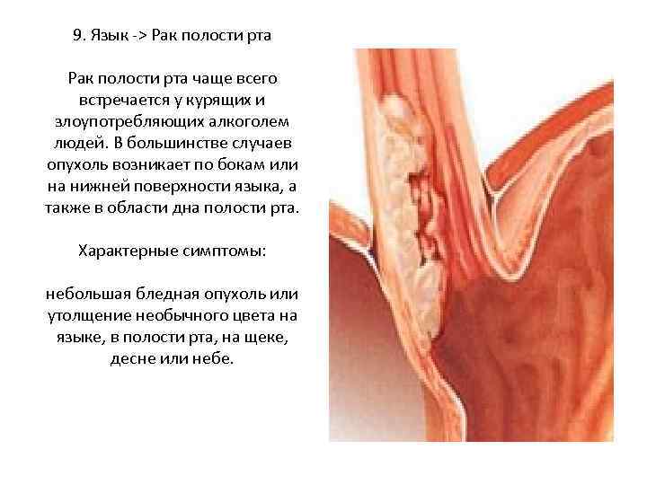 9. Язык -> Рак полости рта чаще всего встречается у курящих и злоупотребляющих алкоголем