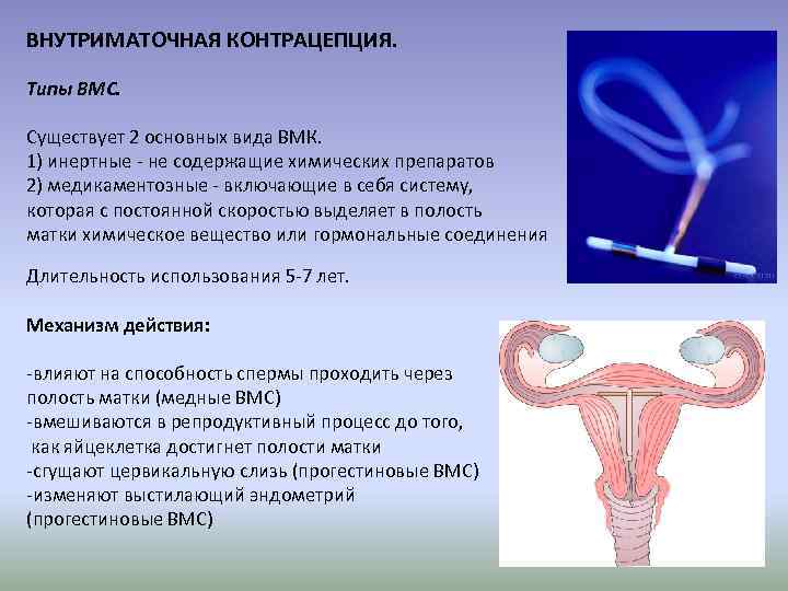 После введение спирали. Внутриматочная спираль методы контрацептивов. Инертные внутриматочные контрацептивы. . Внутриматочные противозачаточные средства (спирали). Гормональная контрацепция ВМС Мирена.