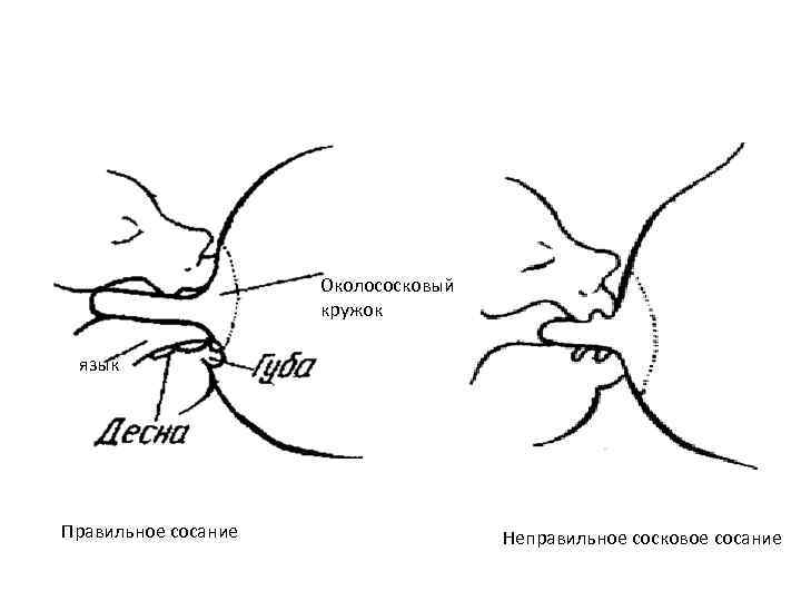 Околососковый кружок язык Правильное сосание Неправильное сосковое сосание 