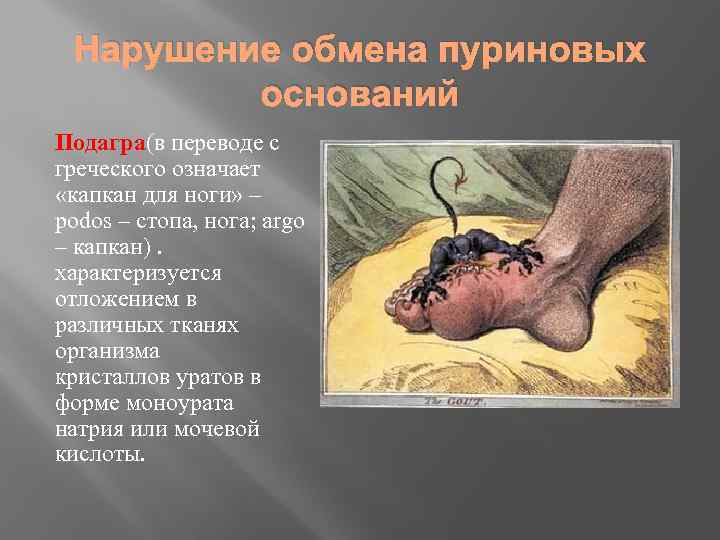 Нарушение обмена пуриновых оснований Подагра(в переводе с греческого означает «капкан для ноги» – podos