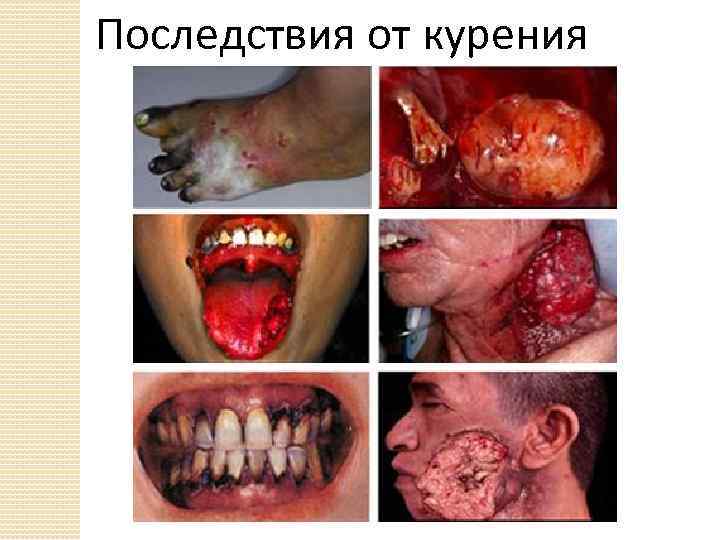 Последствия от курения 