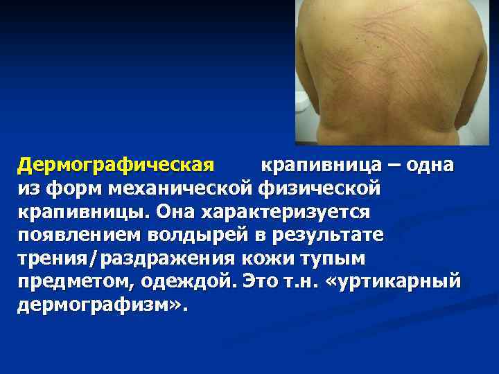 Дермографическая крапивница – одна из форм механической физической крапивницы. Она характеризуется появлением волдырей в