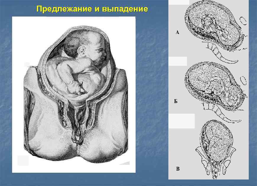 Предлежание и выпадение 