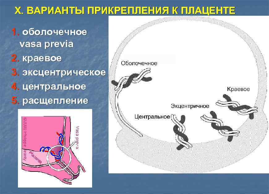 X. ВАРИАНТЫ ПРИКРЕПЛЕНИЯ К ПЛАЦЕНТЕ 1. оболочечное vasa previa 2. краевое 3. эксцентрическое 4.