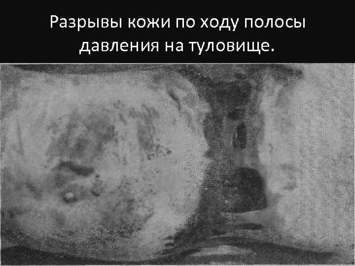 Разрывы кожи по ходу полосы давления на туловище. 