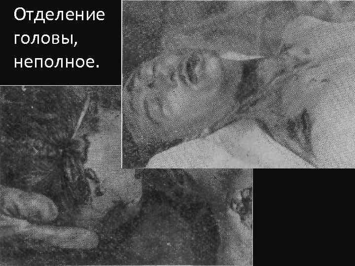Отделение головы, неполное. 