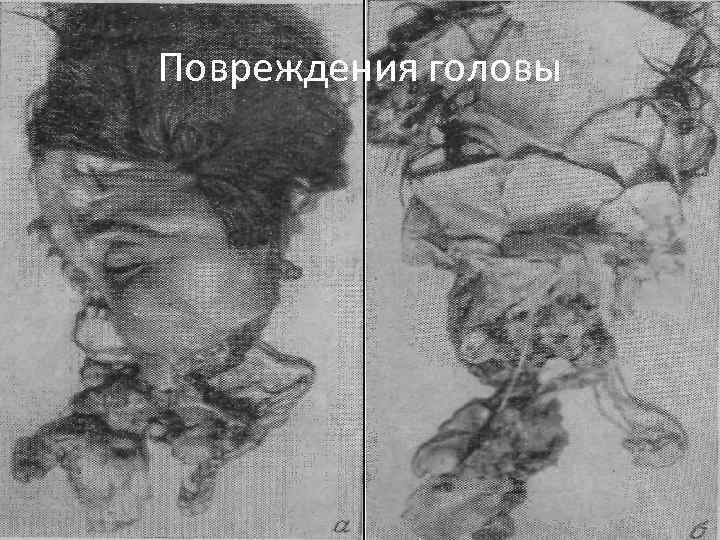 Повреждения головы 