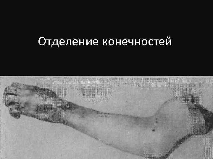 Отделение конечностей 