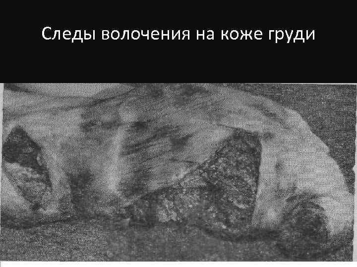 Следы волочения на коже груди 