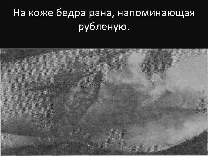 На коже бедра рана, напоминающая рубленую. 