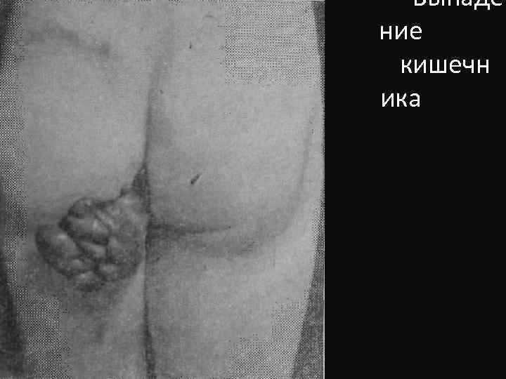 Выпаде ние кишечн ика 