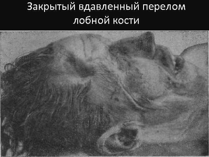 Закрытый вдавленный перелом лобной кости 