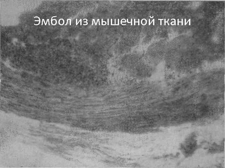 Эмбол из мышечной ткани 