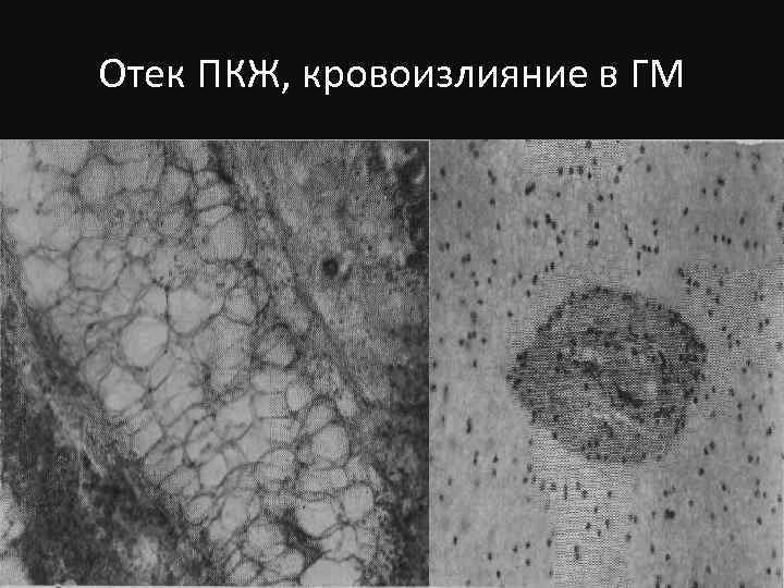 Отек ПКЖ, кровоизлияние в ГМ 