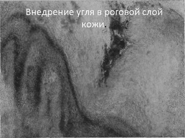 Внедрение угля в роговой слой кожи. 